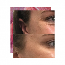 Before and After Crows Feet