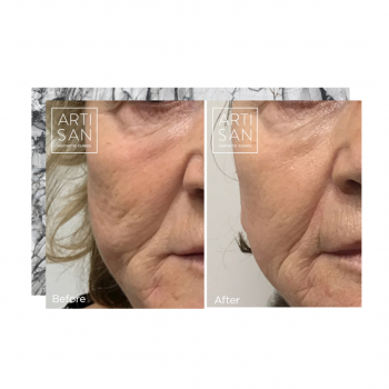 Fraxel Laser skin treatment results 01