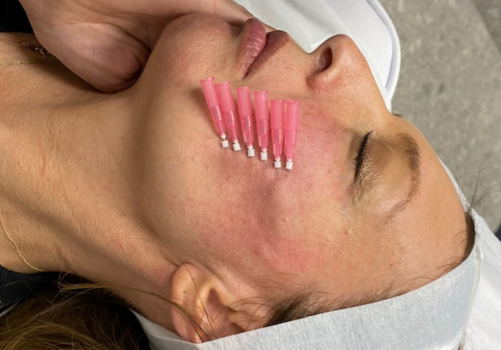 V-Line facial thread lifting – i-Aesthetic