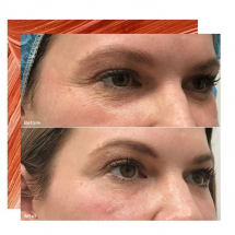 Before and After Crows Feet