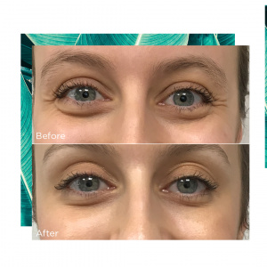 Before & after - Antiwrinkle