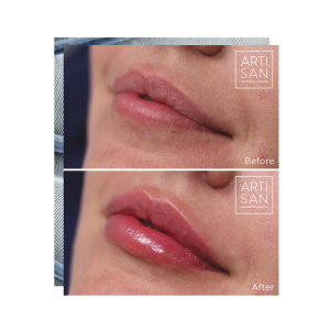Before & after - Lip filler