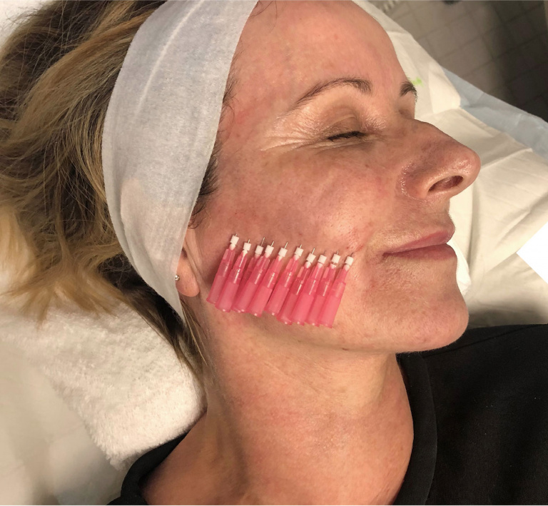 Are PDO smooth threads the new antiwrinkle? Artisan Aesthetic Clinics