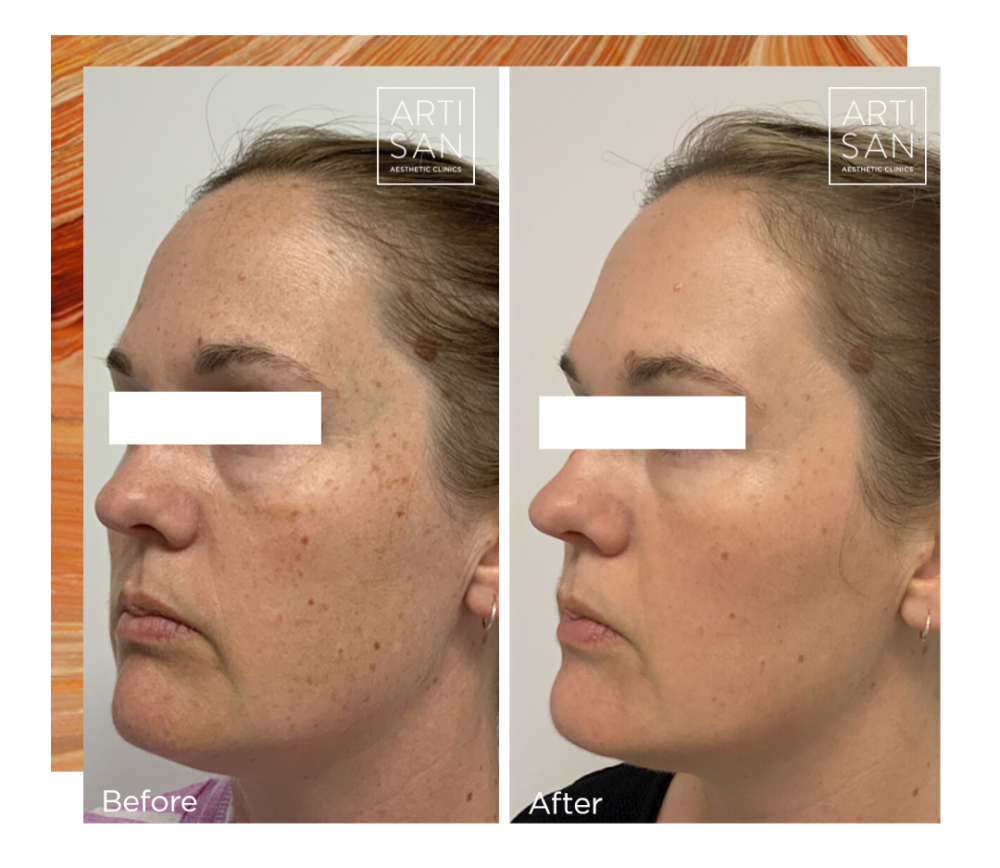 Fraxel dual laser facial treatment