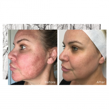 Fraxel Laser skin treatment results 10