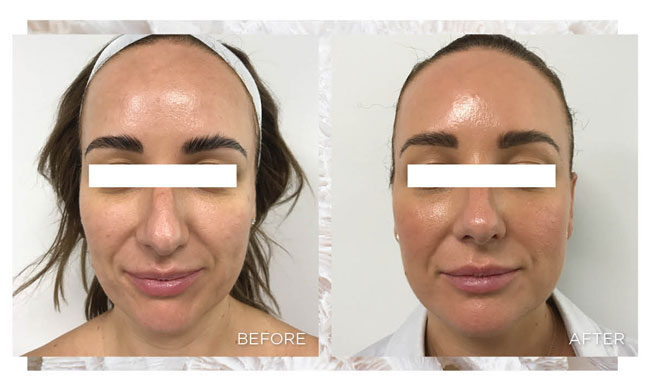 Thermage skin tightening results